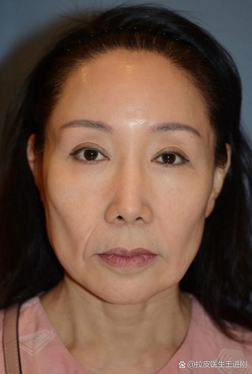 苹果x面容识别戴口罩
