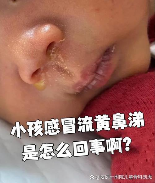 鼻子不通气,流黄鼻涕图标
