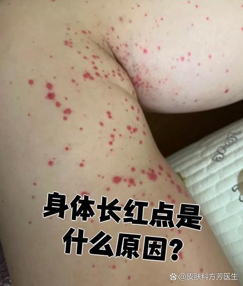 身体出现小红点后来变黑