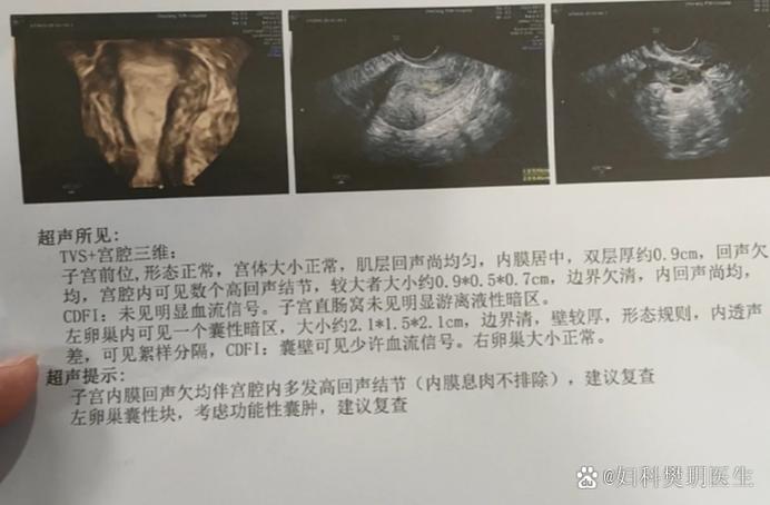 怎么判断自己子宫息肉截图