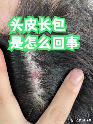 头上长红包是什么原因造成的缩略图