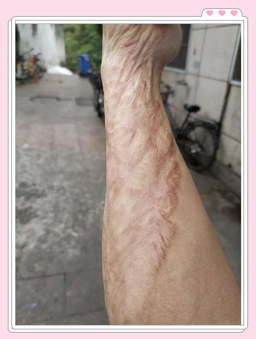 疤痕颜色深怎么淡化