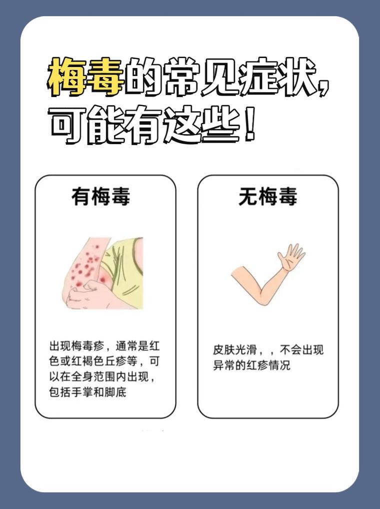 隐性梅毒会传染吗图标