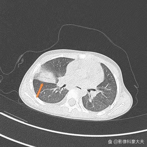 怎么把ct片子做成电子版
