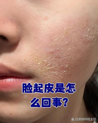 脸上换肤退掉一层皮缩略图