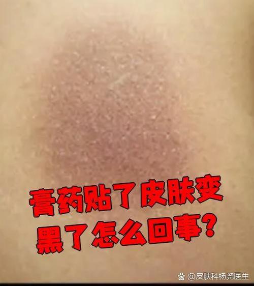 黑膏药粘在皮肤上图标
