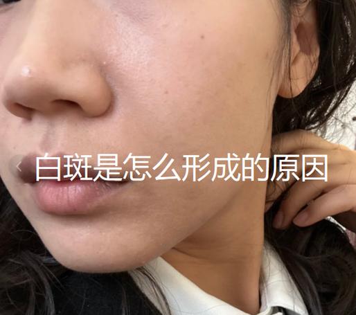 皮肤颜色不均匀有白色