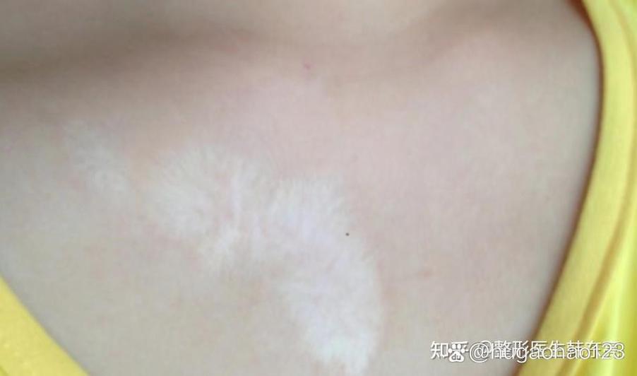 白色疤痕黑色素恢复