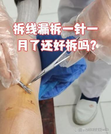 漏了一针怎么补救截图