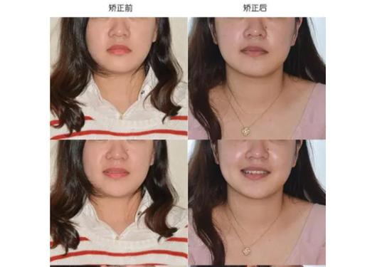 为什么后置拍的脸歪截图