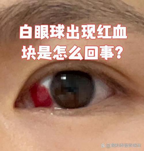 眼睛里有红血块是什么原因截图