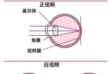 近视眼矫正多少钱截图