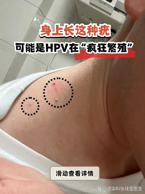 人乳头瘤病毒疣体图片图标