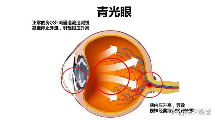 青光眼PPT图片