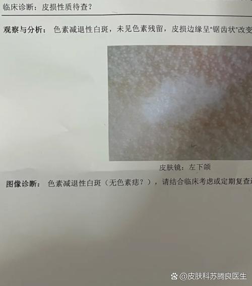 白斑发亮反光是什么情况图标
