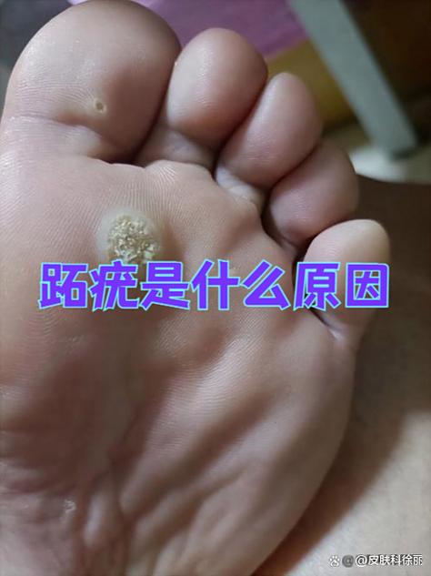 脚病毒感染怎么治疗图标