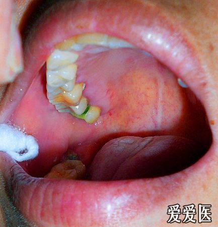 红斑的图片截图