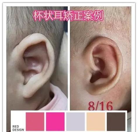 耳朵畸形整形价格截图