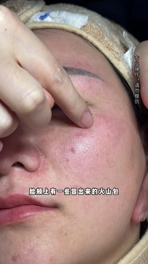 脸上长红包是什么原因造成的缩略图