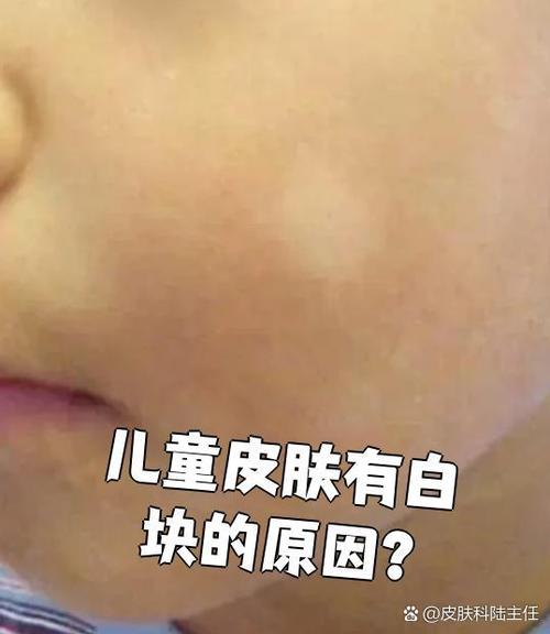 皮肤出现可小的白块截图