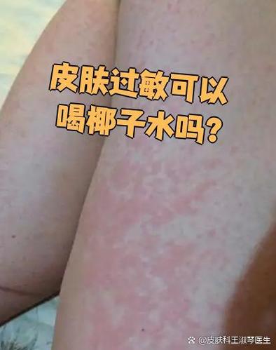 椰子水过敏十大表现截图