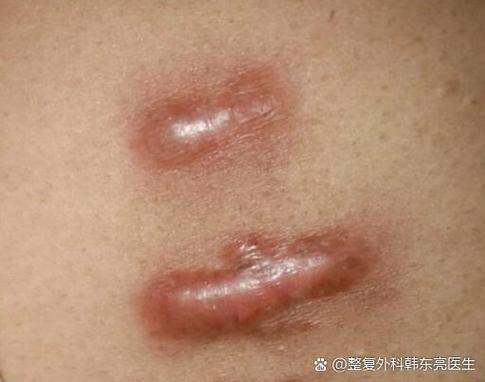 疤痕怎么恢复正常肤色图标